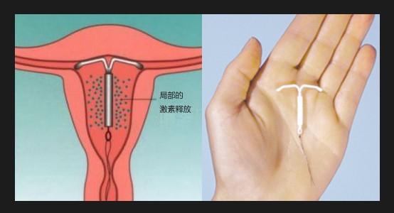 上环后要注意什么？还需注意这6项